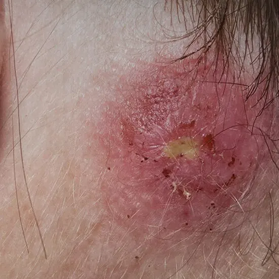 Staphylococcal Infection